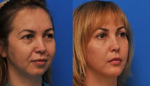 bőrfiatalítás előtt és után feszesítő fotóval 1