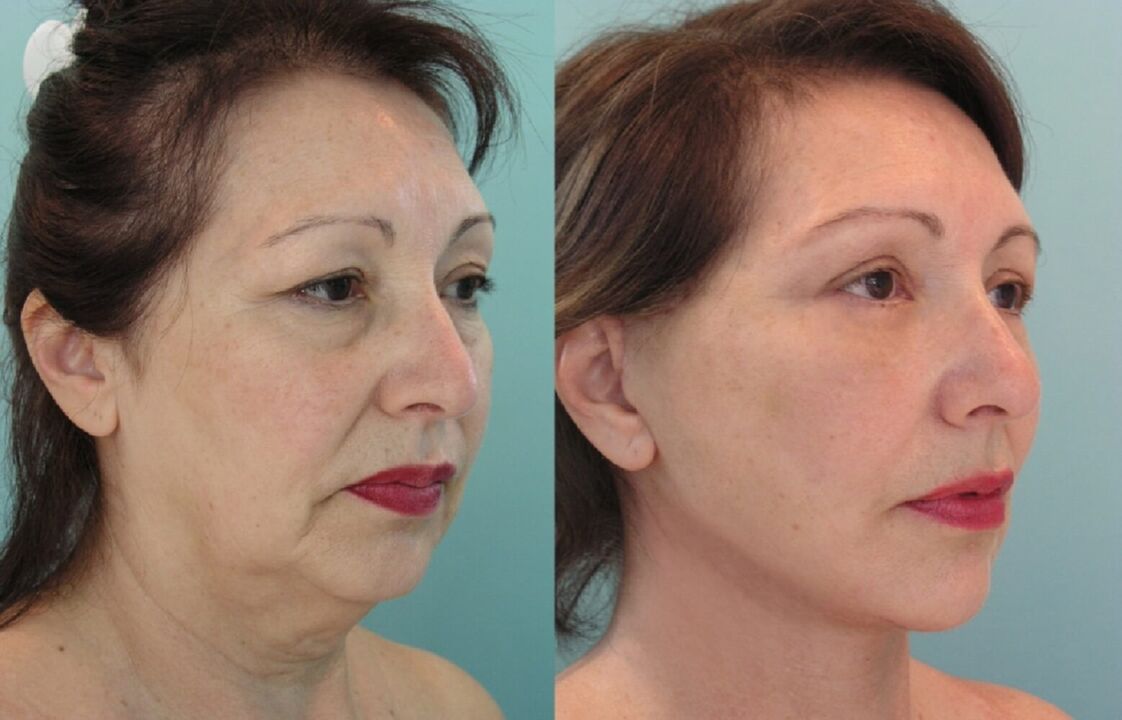 A cérnás arcplasztika előtt és után