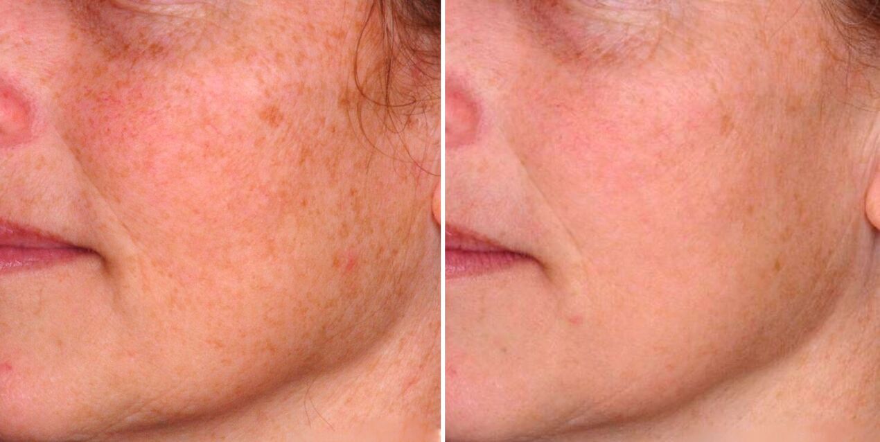 A frakcionált fototermolízis eredménye az öregségi foltok csökkenése az arc bőrén. 