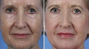 frakcionált arcfiatalítás a fotók előtt és után